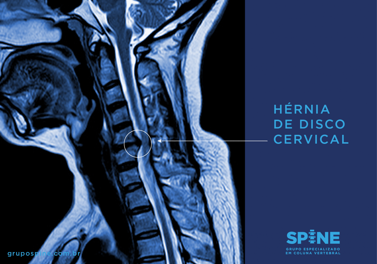 Intumescências Cervical E Lombar - RETOEDU