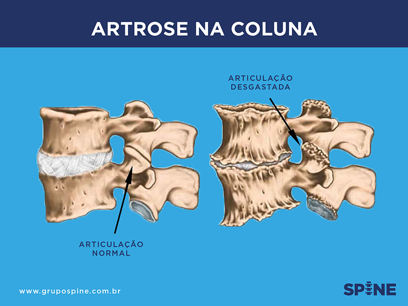 Grupo Spine | Artrose
